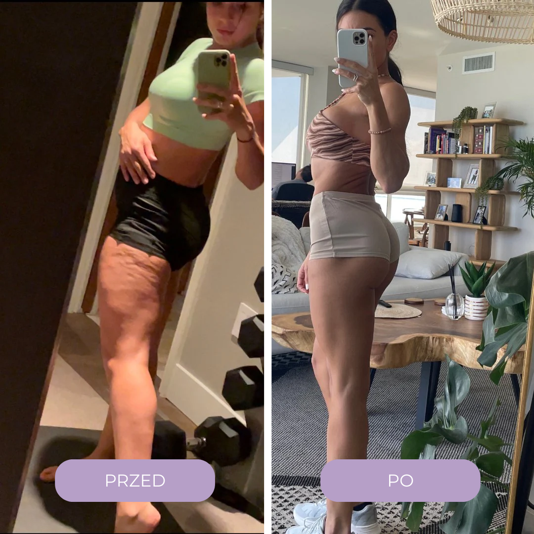 Masażer antycellulitowy Cuddlié